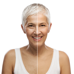 Dermal Fillers